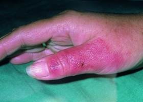 Болезнь рожа на руке, фото начальной стадии Болезнь рожа на руке, фото начальной стадии