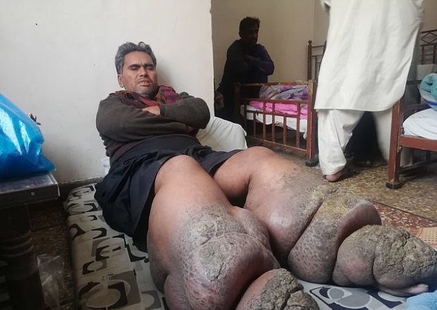 Больной слоновой болезнью