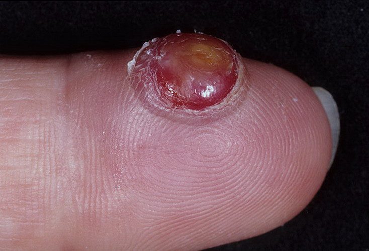 Ботриомикома на пальце