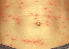 Симптомы тифа Симптомы тифа