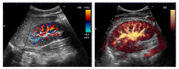 ЦДК и ЭДК сосудов почки ЦДК и ЭДК сосудов почки