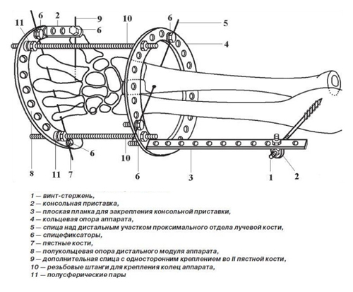Схема выполнения разработанного способа чрескостного остеосинтеза переломов дистального эпиметафиза лучевой кости Схема выполнения разработанного способа чрескостного остеосинтеза переломов дистального эпиметафиза лучевой кости