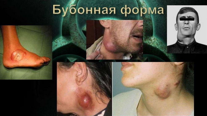 chuma-bubonnaya-chuma bubonnaya Чума (бубонная чума)