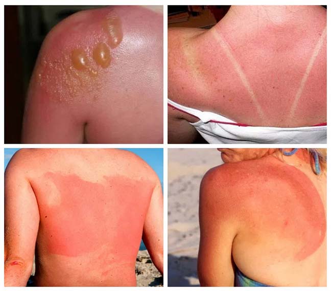 colnechnyj-ozhog foto Cолнечный ожог