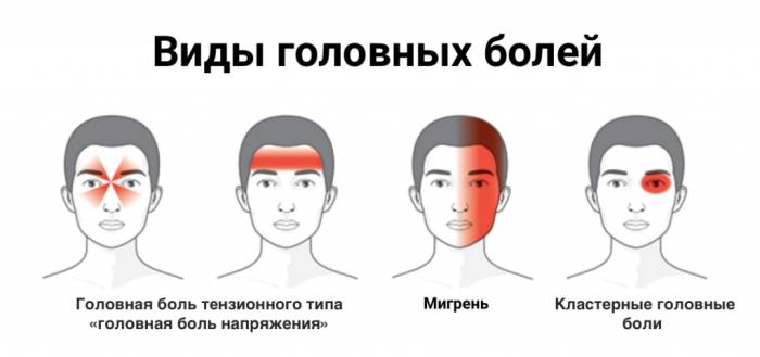 czefalgiya 1 Цефалгия