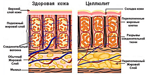 czellyulit stroenie Целлюлит