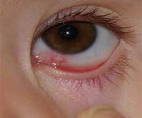 dakrioadenit-vos…-sleznogo-kanala foto Дакриоаденит, воспаление слезного канала