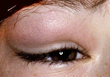 dakrioadenit-vos…-sleznogo-kanala foto2 Дакриоаденит, воспаление слезного канала