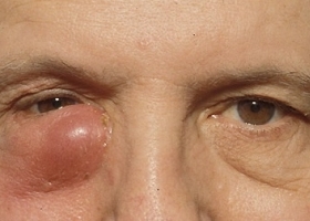 Дакриоцистит, фото Дакриоцистит, фото