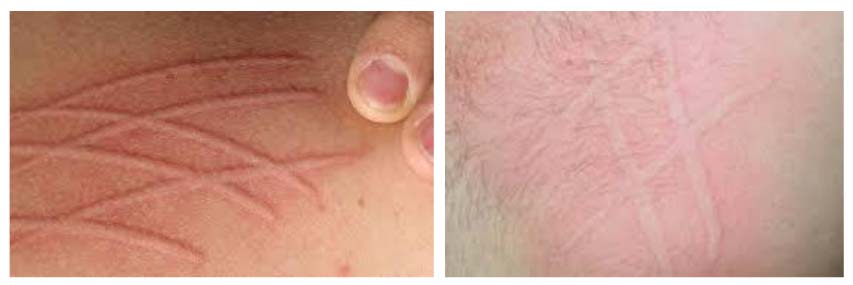 dermografizm 1 Дермографизм