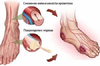 Диабетическая ангиопатия нижних конечностей Диабетическая ангиопатия