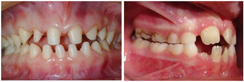 Дисплазия соединительной ткани Дисплазия соединительной ткани
