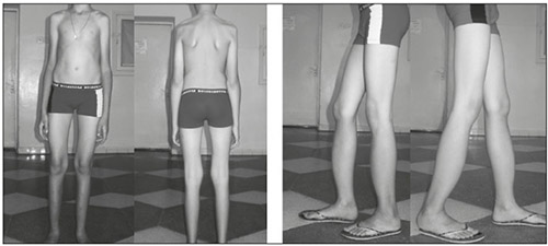 Дисплазия соединительной ткани Дисплазия соединительной ткани