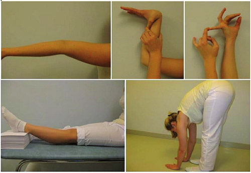 Дисплазия соединительной ткани Дисплазия соединительной ткани