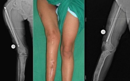 Дисплазия соединительной ткани Дисплазия соединительной ткани