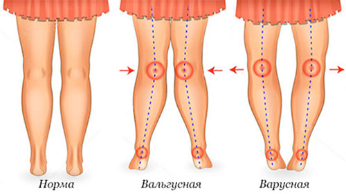 Дисплазия соединительной ткани Дисплазия соединительной ткани