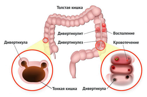 Дивертикулез толстой кишки Дивертикулез толстой кишки