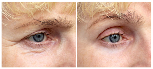 До и после операции блефаропластики До и после операции блефаропластики