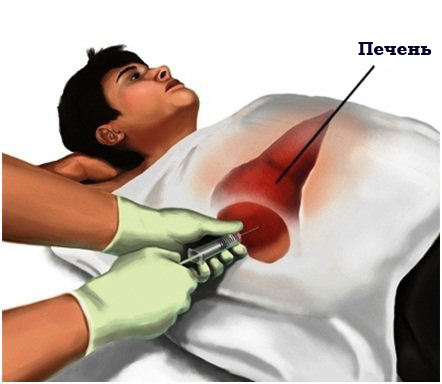 Дренирование абсцесса печени