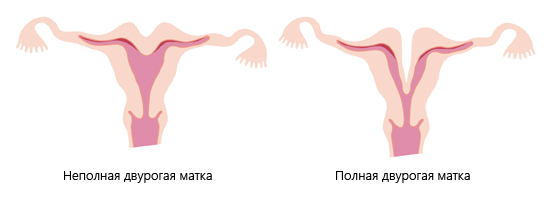 Разновидности двурогой матки Разновидности двурогой матки