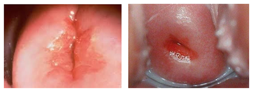 ektopiya-shejki-…ki-endoczervikoz foto Эктопия шейки матки (эндоцервикоз)
