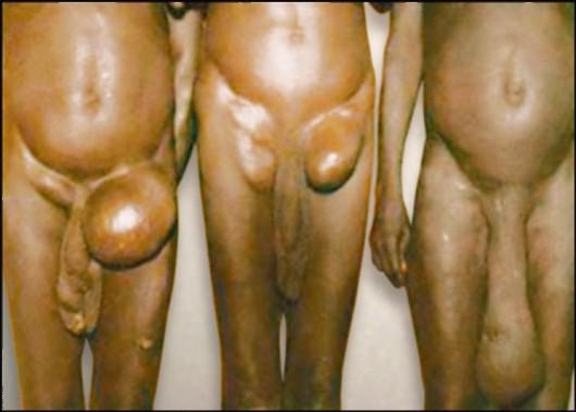 Элефантиаз мошонки Элефантиаз