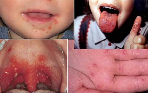 Энтеровирусная инфекция (энтеровирус) Энтеровирусная инфекция (энтеровирус)