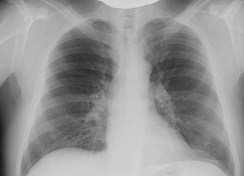 Фиброз легких Фиброз легких