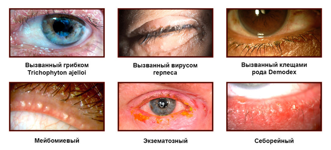 Формы блефарита Формы блефарита