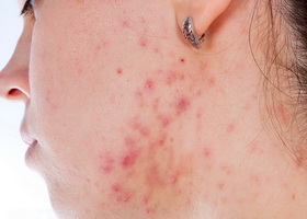 Фото лица при хеликобактер пилори Фото лица при хеликобактер пилори