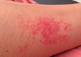 Фото симптомов аллергического васкулита Фото симптомов аллергического васкулита