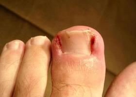 Фото вросшего ногтя на большом пальце ноги Фото вросшего ногтя на большом пальце ноги