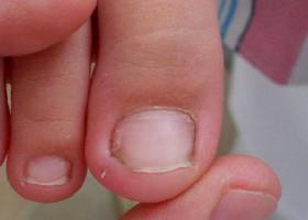 Фото вросшего ногтя Фото вросшего ногтя