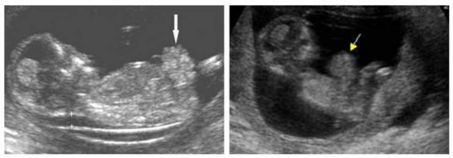 gastroshizis 1 Гастрошизис