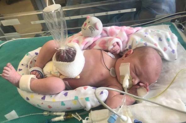 gastroshizis 2 Гастрошизис