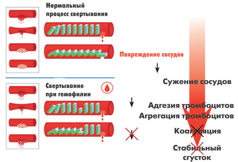 gemofiliya prozess Гемофилия