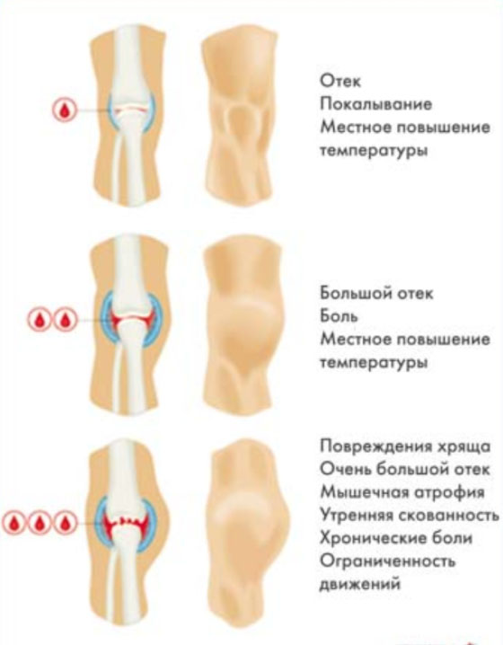 gemofiliya stepeni Гемофилия