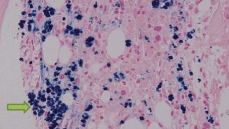 Гемосидероз костного мозга