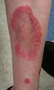 Гемосидероз кожи