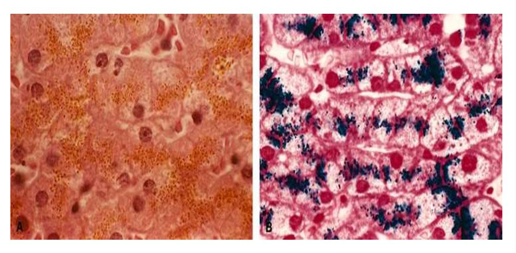 Гемосидероз печени