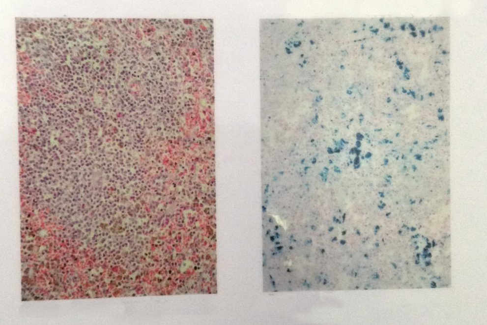 Гемосидероз селезенки слева - окраска гематоксилином эозином, справа - реакция Перлса