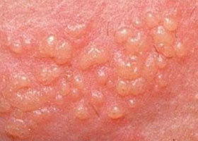 genitalnyj-gerpes simptomy Генитальный герпес