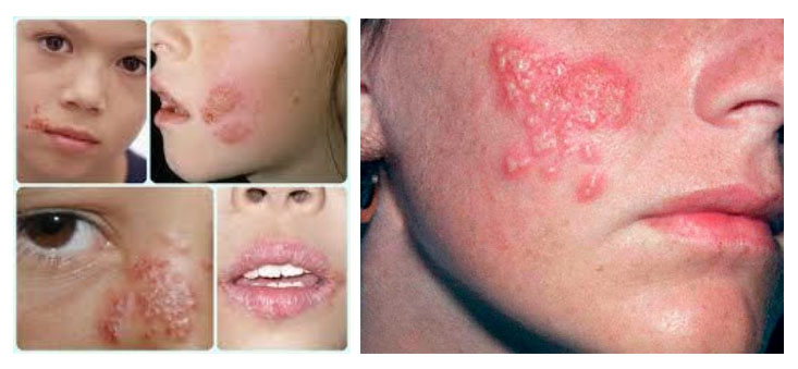 gerpes-na-tele foto Герпес на теле