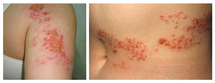 gerpes-na-tele foto4 Герпес на теле