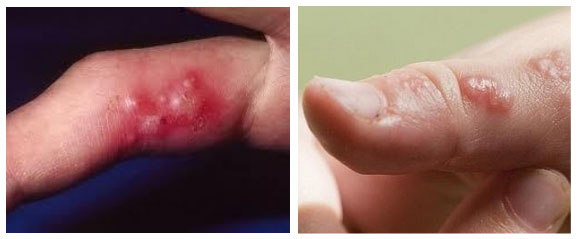 gerpes-na-tele foto5 Герпес на теле