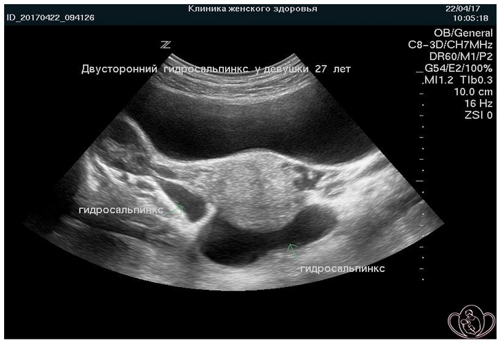 gidrosalpinks analizy Гидросальпинкс
