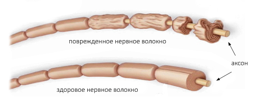 Синдром Гийена-Барре Синдром Гийена-Барре