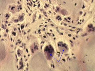 Гигантские клетки инородных тел в подагрической шишке