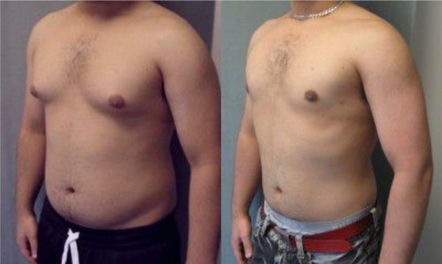 ginekomastiya foto Гинекомастия