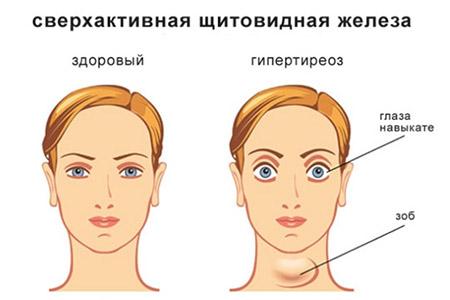 Гиперплазия щитовидной железы Гиперплазия щитовидной железы